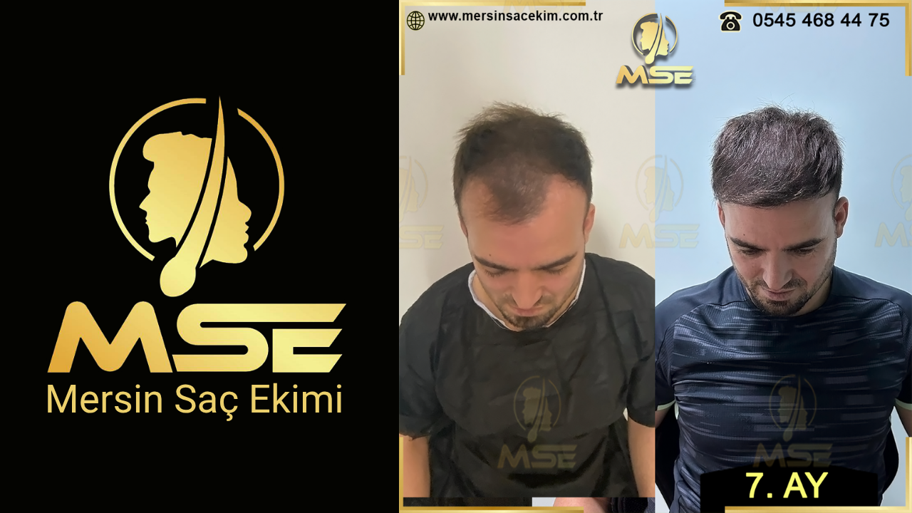MERSİN SAÇ EKİMİ